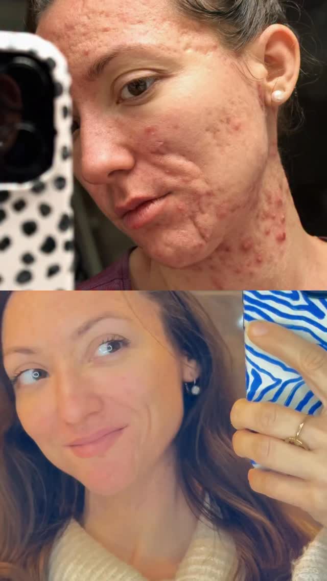 Il y a un an, au mois de novembre, je ne reconnaissais plus ma peau.
Des boutons partout : mâchoire, cou, dos étaient revenus.
Je vous l’avais partagé : j’étais épuisée, peinée et je ne comprenais plus ce qui m’arrivait.
Aujourd’hui, ce même mois de novembre… ma peau n’a plus rien.
Et c’est exactement pour ça que je vous partage cet avant/après : les choses peuvent évoluer quand on soulève les bons leviers. Toujours.
Mais seulement quand on trouve les causes.
Après des semaines à tout analyser, j’avais finit par comprendre ce qui me déclenchait ces inflammations cutanées : les produits laitiers.
Même ceux de chèvre et de brebis.
J’en avais réintroduit depuis 7 mois : un yaourt de brebis par ci, du fromage blanc de chèvre au petit-déjeuner… et parfois du beurre ou de la crème au restaurant alors qu’avant je faisais toujours attention à demander de les enlever au maximum.
Je pensais que ça “m’apportait beaucoup” sur le plan nutritionnel et notamment encore d’avantage de protéines.
En réalité, ça surchargeait une voie métabolique clé : la voie mTOR, activée entre autres par la leucine (un acide aminé très présent… dans les produits laitiers y compris ceux de petits gabarits comme la brebis et la chèvre).
Et quand mTOR s’emballe, la prolifération cellulaire augmente.
Sur une peau sensible à l’acné, prolifération cellulaire = poussées inflammatoires, kystes, boutons en chaîne.
Bref : ce n’était pas ma peau le problème, comme d’habitude, c’était un déclencheur. Et dans ce cas, un déclencheur alimentaire qui n’était pas adapté pour moi.
Qui je pense n’est adapté pour personne qui souffre d’une peau inflammée ou d’une sphère ORL congestionnée d’ailleurs. Mais je vous en parlerai dans un autre post.
Cet avant/après, c’est pour vous rappeler qu’on ne “subit” pas sa peau pour toujours.
Qu’il y a toujours une logique, un terrain, une cause.
Et quand on la trouve : tout change.