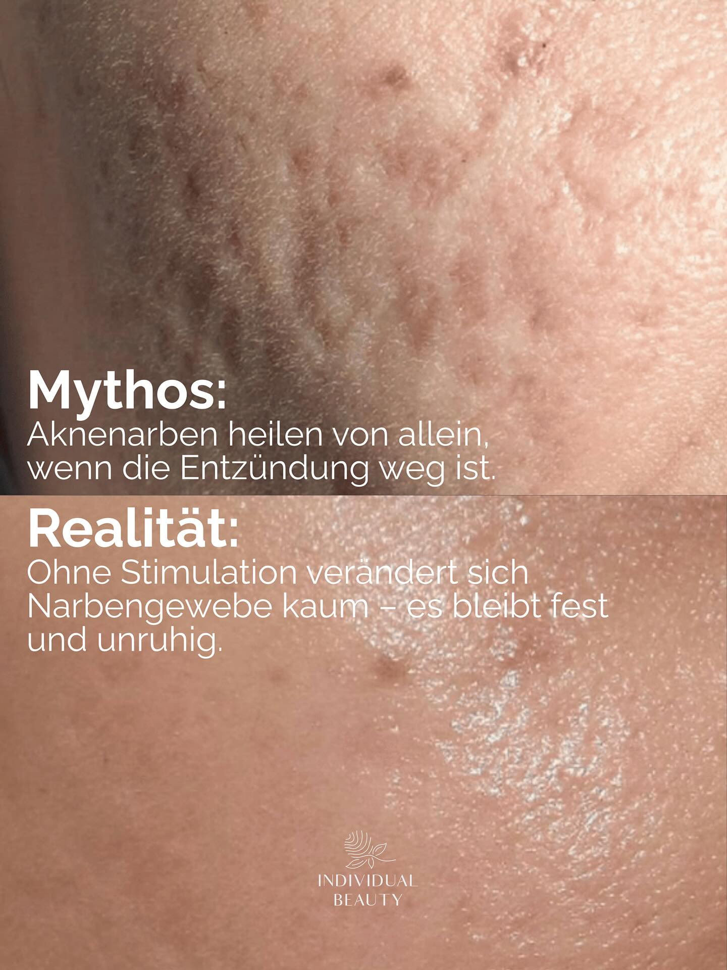 Narben erzählen eine Geschichte – aber sie müssen nicht für immer sichtbar bleiben. 
Mit Methoden wie dem Plasma Pen unterstützen wir die Haut dabei, sich selbst zu erneuern.
Und genau das macht den Unterschied, ob es unverändert bleibt oder sich sichtbar verbessert.
#wienbeauty #viennabeauty #plasmapen #narben #aknenarben #narbenbehandlung #narbenpflege #aknebehandlung #hautpflege #skincare #hautgesundheit #beautytreatment #beautycommunity #skincarecommunity #wien #vienna #austria #wienliebe
