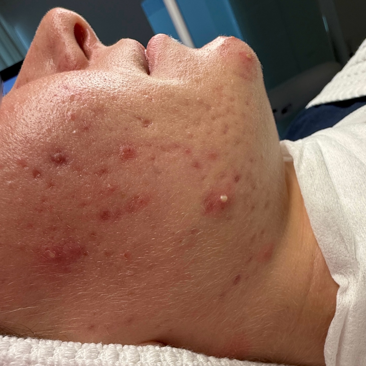 Zwischen diesen Bildern liegen nur 2 Behandlungen und medizinische Heimpflege.
Indikation: Bei dieser Kundin lag eine ausgeprägte entzündlich-pustulöse Akne vor. Diese Form der Akne ist durch tiefsitzende, entzündliche Läsionen gekennzeichnet, die häufig mit Schmerzen, Rötungen und langanhaltenden Entzündungsprozessen einhergehen. Durch wiederkehrende Entzündungen in tieferen Hautschichten kam es im Verlauf zur Schädigung des Gewebes und damit zur Entstehung von Aknenarben und ungleichmäßiger Hautstruktur.
Unser Behandlungsziel war es, die aktiven Entzündungen zu reduzieren, die Talgproduktion zu regulieren, die Hautbarriere zu stabilisieren und bestehende Narbenbilder schrittweise zu verbessern.
Gearbeitet wurde mit hochwirksamen, medizinisch orientierten Produkten von ZO Skin Health @zoskinhealth in der Heimpflege in Kombination mit einem individuell abgestimmten Peeling. Diese Behandlungsmethode fördert die Zellregeneration, verfeinert das Hautrelief und unterstützt eine nachhaltige Normalisierung des Hautzustandes.
Das Ergebnis zeigt deutlich: eine sichtbar beruhigte Haut, weniger Entzündungen, verfeinerte Poren und ein insgesamt gleichmäßigeres Hautbild. Wir starten nun mit @skinpen für die Narben. ?
Jede Haut benötigt ein individuelles Konzept – genau das steht bei mir im Mittelpunkt jeder Behandlung.
Du leidest ebenfalls unter Akne oder Aknenarben und wünschst dir professionelle Unterstützung?
Ich berate dich zusätzlich mit einer digitalen Hautanalyse in meinem Kosmetikstudio in Hannover.
Informationen | Terminvereinbarung
? 0162/ 1723052 - WhatsApp
? info@skinconcept-Hannover.de
? www.skinconcept-Hannover.de
Kosmetik Hannover | hydrafacial Hannover | Hautanalyse Hannover | Microneedling Hannover | dauerhafte Haarentfernung Hannover