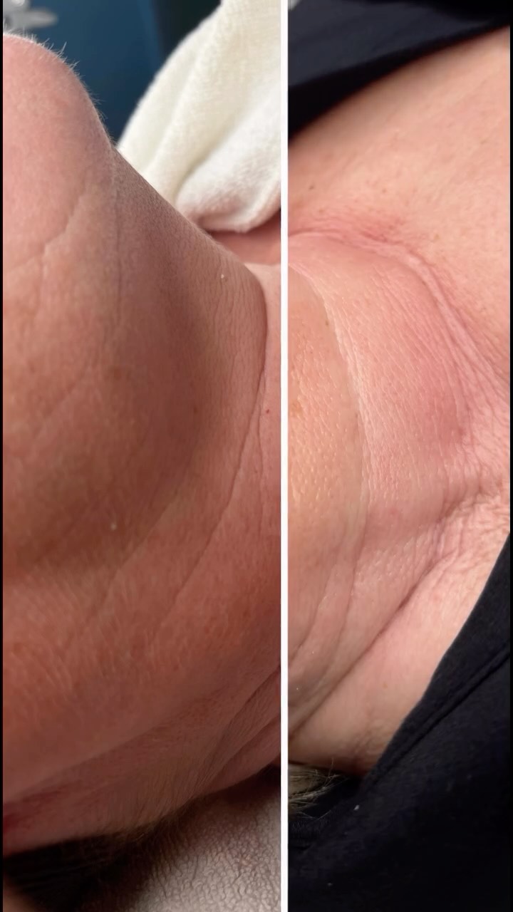 Auf diesem Bild seht ihr den Hals sowie Jawline Bereich meiner Kundin vor und nach mehreren Forma-Behandlungen.
Forma arbeitet mit kontrollierter Radiofrequenzenergie, die tief in die Haut eindringt und dort die Kollagen- und Elastinproduktion stimuliert.
Das Ergebnis:
• sichtbar straffere Haut
• glattere Konturen
• ein insgesamt frischeres, jugendlicheres Hautbild
Die Behandlung ist nicht invasiv, angenehm warm und erfordert keine Ausfallzeit. Besonders empfindliche Areale wie der Hals lassen sich damit sehr schön und gleichmäßig behandeln.
Weitere Areale die ich häufig mit Forma behandle:
• Gesicht
• Ober- & Unterlid
• Oberarme
• Knie
➡️ Für optimale Ergebnisse sind mehrere Sitzungen empfehlenswert.
Informationen | Terminvereinbarung
? 0162/ 1723052 - WhatsApp
? info@skinconcept-Hannover.de
? www.skinconcept-Hannover.de
Kosmetik Hannover | hydrafacial Hannover | Hautanalyse Hannover | Microneedling Hannover | dauerhafte Haarentfernung Hannover | Radiofrequenz Hannover
